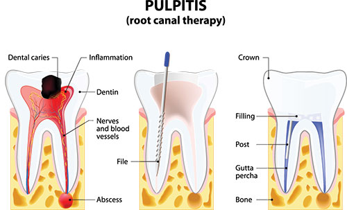 Ditmars Family Dental | Removable Dental Prostheses , Root Canals and Dentures