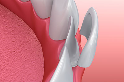 Ditmars Family Dental | Bonding, Removable Dental Prostheses  and Dentures