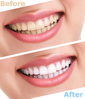 Ditmars Family Dental | Bonding, Implant Dentistry and Root Canals