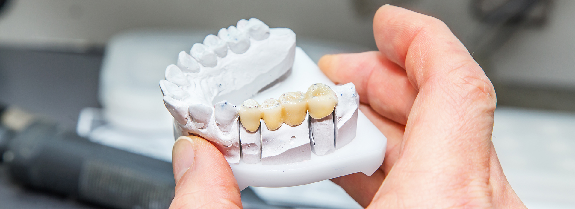 Ditmars Family Dental | Preventative Program, Bone Grafts and Root Canals