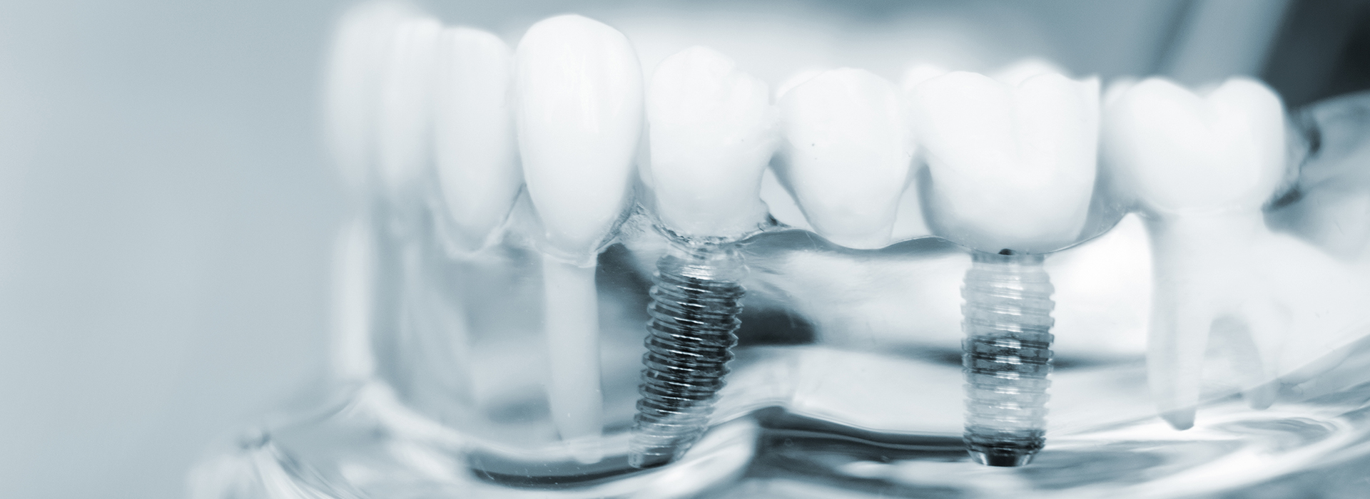Ditmars Family Dental | Preventative Program, Teeth Whitening and Bonding