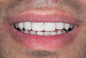 Ditmars Family Dental | Teeth Whitening, Veneers and Root Canals