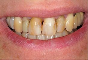 Ditmars Family Dental | Veneers, Implant Dentistry and Root Canals