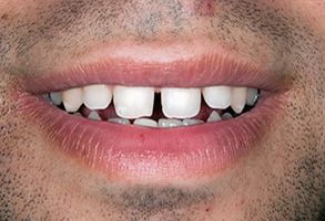 Ditmars Family Dental | Veneers, Preventative Program and Emergency Treatment